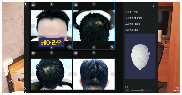 탈모치료잘하는곳? 딱 2가지만 확인하세요 - 17년 차 의사 관련 이미지 3