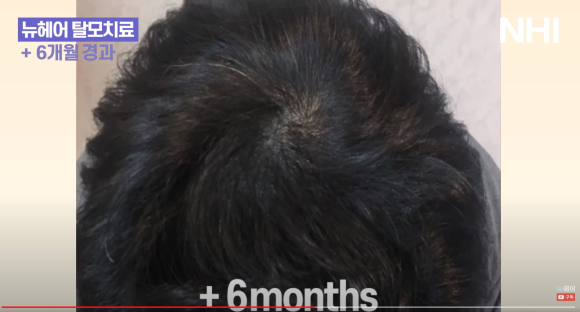 뉴헤어 탈모치료(모낭주사) 6개월 후기 l 전후사진 관련 이미지 5