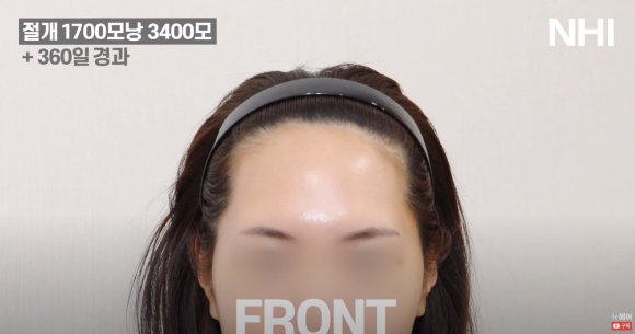 여자 이마 작아지는 헤어라인 교정 (모발이식) 1700모낭 1년 후 관련 이미지 2