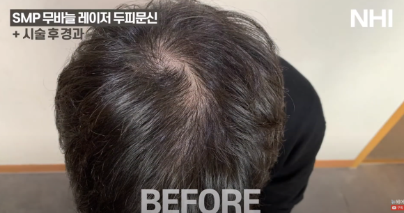 [뉴헤어] 남자 두피문신 정수리 전후사진 + 영상 관련 이미지 2