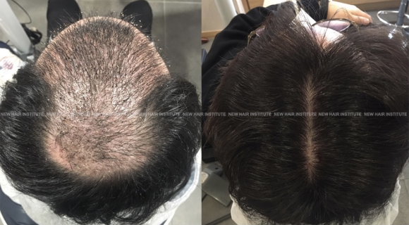 정수리 탈모 = 모낭주사, 뉴헤어 리얼 전후 사진 관련 이미지 1