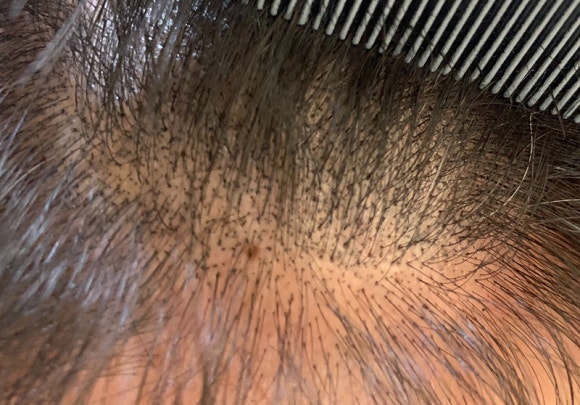 탈모가 있으면 모발이식부터 해야 할까요?(탈모치료 방법) 관련 이미지 4