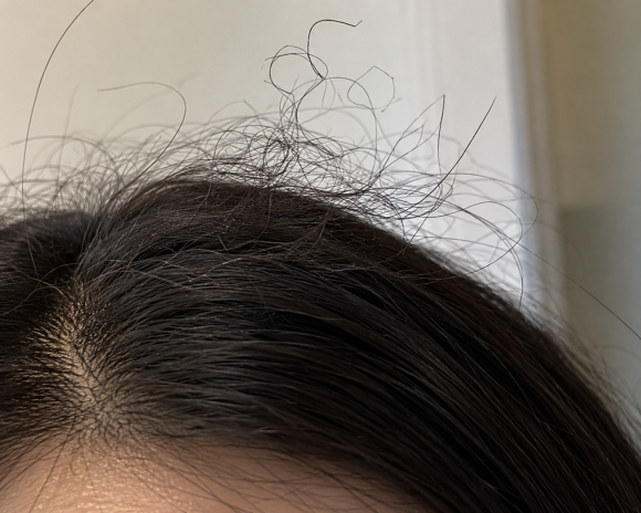 Why Do Coarse, Curly Hairs Grow on the Head? Is It Normal? Causes and Care image 3