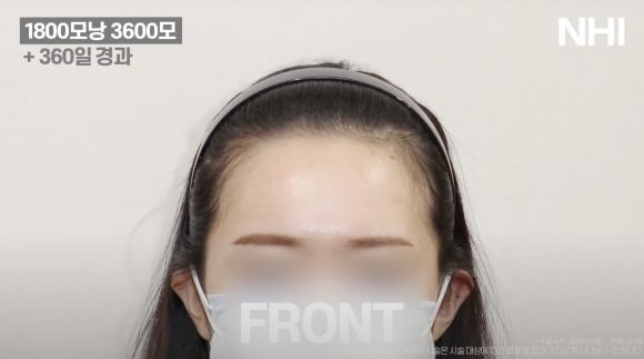 헤어라인교정 #여자모발이식 1800모낭 1년 후기 사진 관련 이미지 1