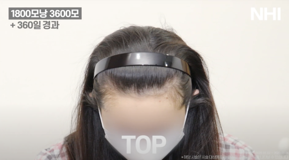 헤어라인교정 #여자모발이식 1800모낭 1년 후기 사진 관련 이미지 5