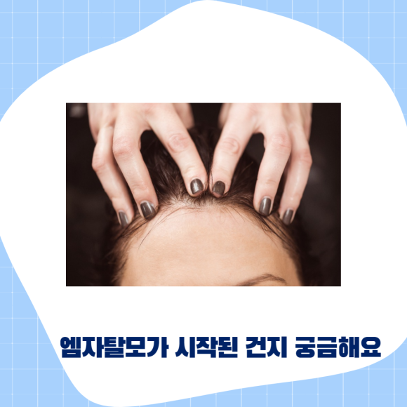 엠자탈모 확실한 치료법은? 관련 이미지 2