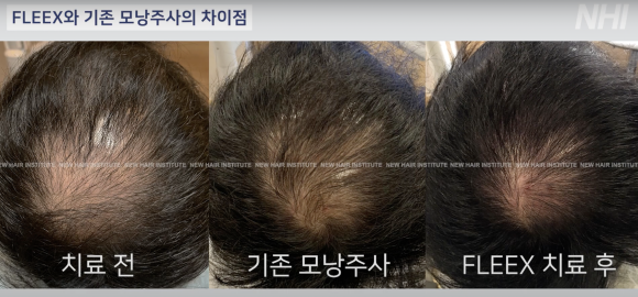 모낭주사 탈모주사 효과 l 엑소좀 탈모치료 효과 비교 관련 이미지 2