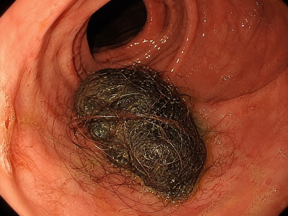 What Happens If You Eat Hair? Is There a Risk to the Pancreas? image 3