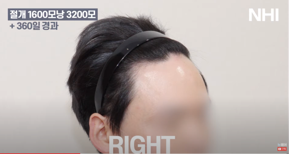 [뉴헤어] 남성 탈모 모발이식 1년 후 사진 공개합니다 관련 이미지 4