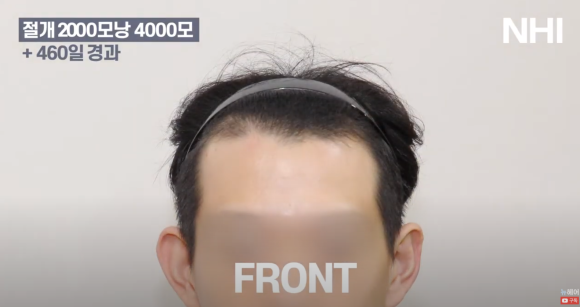 [뉴헤어] 남자 모발이식 후기 2000모낭 심고 460일 지났습니다 관련 이미지 1
