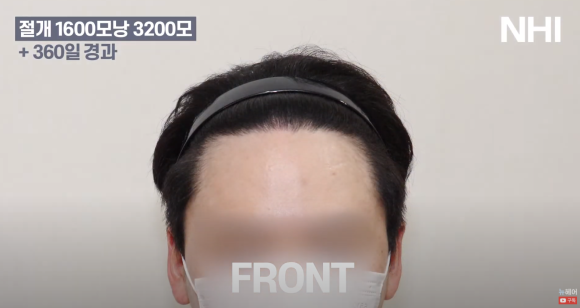 [뉴헤어] 남성 탈모 모발이식 1년 후 사진 공개합니다 관련 이미지 3