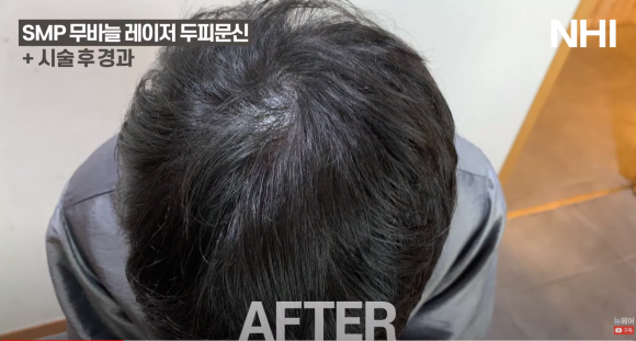 [뉴헤어] 남자 두피문신 정수리 전후사진 + 영상 관련 이미지 3
