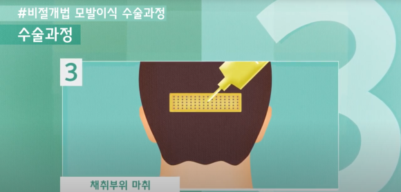 모발이식 수술 뉴헤어에서 알아보기(절개,비절개,헤어라인,모발이식방법,수술) 관련 이미지 11