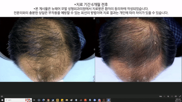 Male Crown Hair Loss: Is Autologous Cell Therapy Possible? image 1