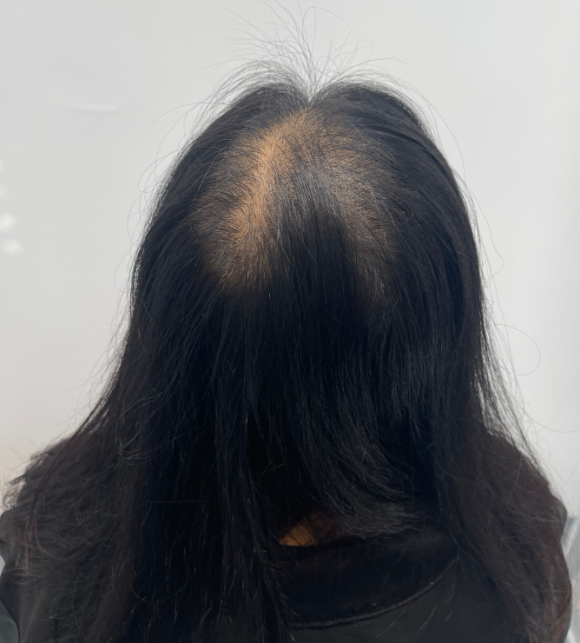 모발문신후기? 탈모치료와 병행한 40대 여성 환자분 사례 관련 이미지 5