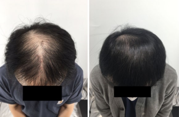 모낭주사, 아무도 말해주지 않는 2가지 비밀 관련 이미지 1