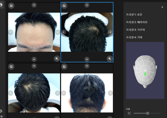 모발이 얇아지고 있다? 탈모검사로 골든타임 지키자 관련 이미지 5