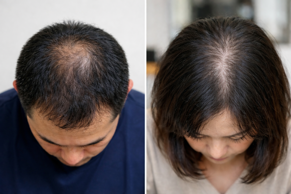 정수리 탈모 초기? 증상과 원인 그리고 치료 방법 관련 이미지 3
