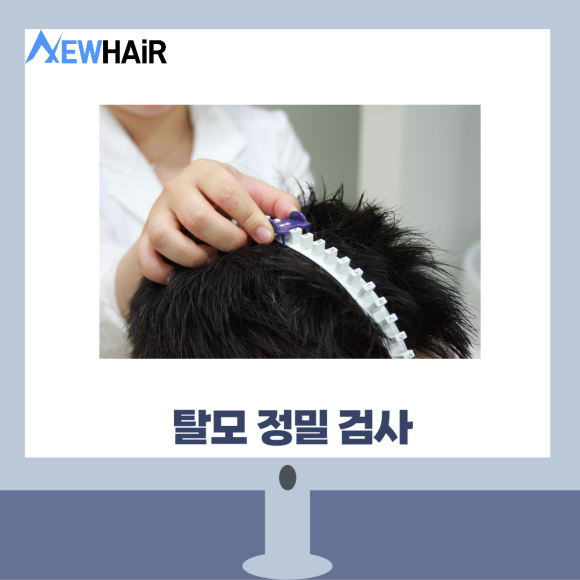 탈모검사비용 제대로 알고 치료하자 관련 이미지 4
