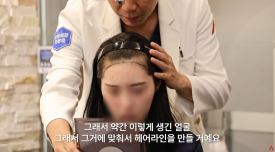 Improving an M-Shaped Hairline: Which Hairline Looks Natural? image 4