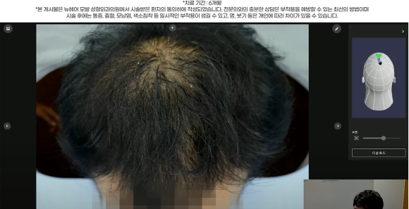 남성 정수리 탈모 치료 수술없이 주사만으로?(탈모약+주사치료) 관련 이미지 10