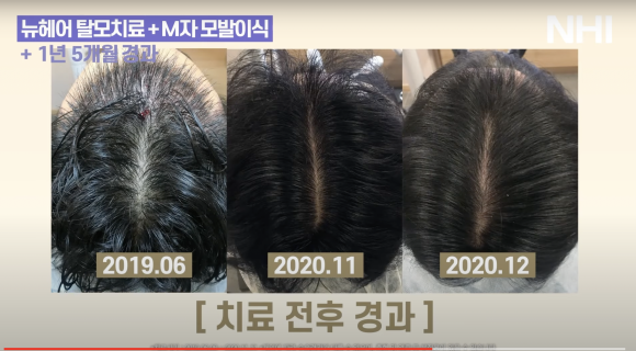 엑소좀 탈모치료 후기 (1년 5개월) 모발이식 + 탈모치료 관리 관련 이미지 2