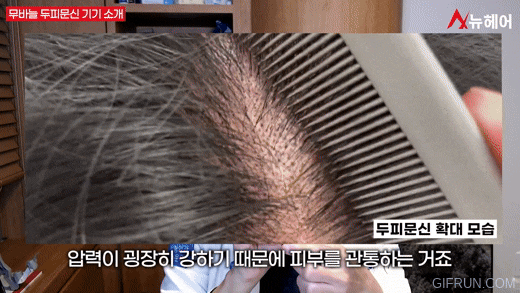 정수리 탈모, 가르마 탈모에 효과적인 무바늘 두피문신! 관련 이미지 6