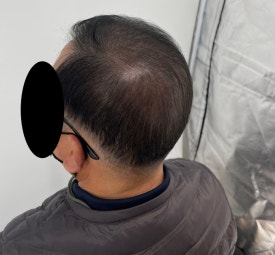 두피문신후기, 60대 남성 사례 전부 공개합니다 관련 이미지 17