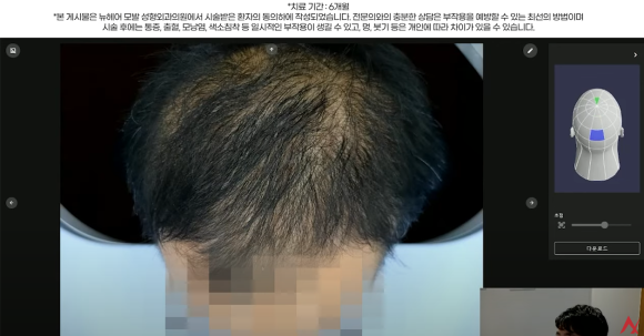 남성 정수리 탈모 치료 수술없이 주사만으로?(탈모약+주사치료) 관련 이미지 9