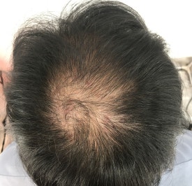 중년탈모관리, 치료를 고민할 때 무엇부터 살펴봐야 할까? 관련 이미지 4