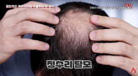 정수리 가르마 모발이식 효과 없다? 실제 결과와 오해 정리 관련 이미지 1