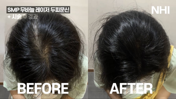 여자 두피문신 l 가르마 탈모 l 정수리 탈모 두피문신 전후 사진 l 뉴헤어 관련 이미지 2