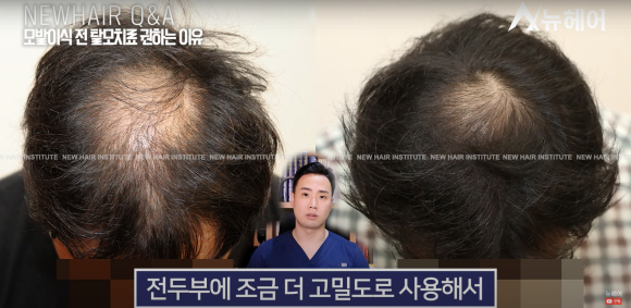 모발이식 알아봐야 한다면 관련 이미지 12