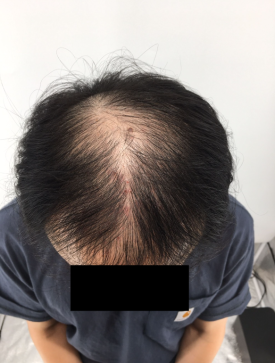 탈모치료주사? 효과 있을까 궁금하신 분들만 보세요 관련 이미지 4