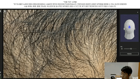 남성 정수리 탈모 치료 수술없이 주사만으로?(탈모약+주사치료) 관련 이미지 8