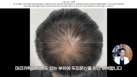 정수리탈모문신 시술직후 나타나는 효과?(전후사진) 관련 이미지 19