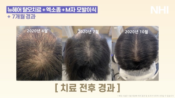 정수리탈모 엑소좀관리 7개월 경과 전후사진 관련 이미지 6
