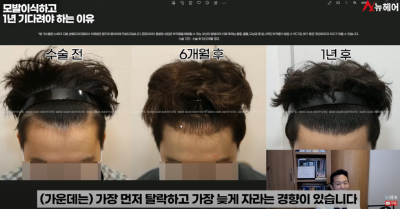 모발이식경과 1년을 기다려야 하는 이유 관련 이미지 17