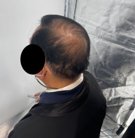 두피문신후기, 60대 남성 사례 전부 공개합니다 관련 이미지 6