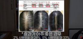 여성탈모는 남성용 미녹시딜을 써라?(효과,부작용) 관련 이미지 5