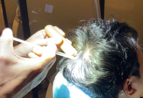 미녹시딜 사용, 여성 탈모에 적합한 치료법은?(효과, 사용법, 부작용) 관련 이미지 5