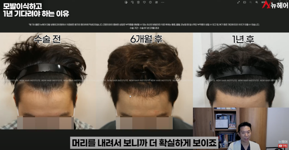 모발이식경과 1년을 기다려야 하는 이유 관련 이미지 18