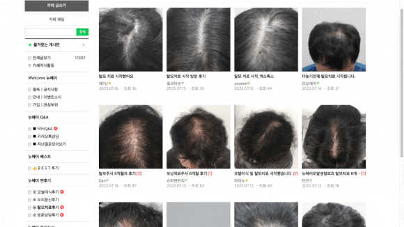 서울탈모치료, 17년차 전문의가 말하는 핵심? 관련 이미지 4
