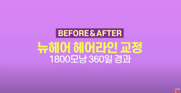 모발이식을 통한 헤어라인 교정, 이마축소효과 전후 사진 보기 관련 이미지 1