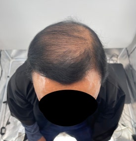 두피문신후기, 60대 남성 사례 전부 공개합니다 관련 이미지 3