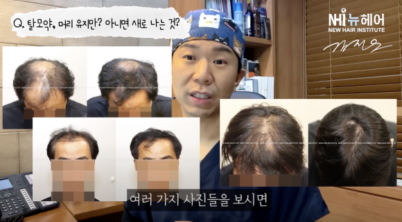 탈모약 효과, 탈모 유지? 머리카락이 새로 나는 경우도 있나요? l 두타스테리드 관련 이미지 7