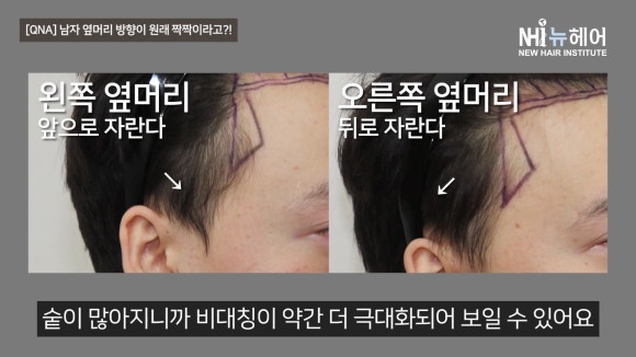 남자 옆머리 방향이 짝짝이일 때? l 모발이식하고 짝짝이가 된 머리, 이유 알려드립니다 관련 이미지 10