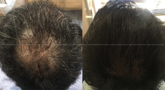 정수리 탈모, 주사 효과 어느 정도일까? 모낭주사 치료 후기 관련 이미지 1