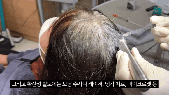 탈모치료방법, 비수술로 해결될까요? 관련 이미지 2