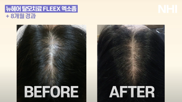 가르마 탈모치료(모낭주사) 8개월 경과 후기 사진 l  탈모치료 관련 이미지 1